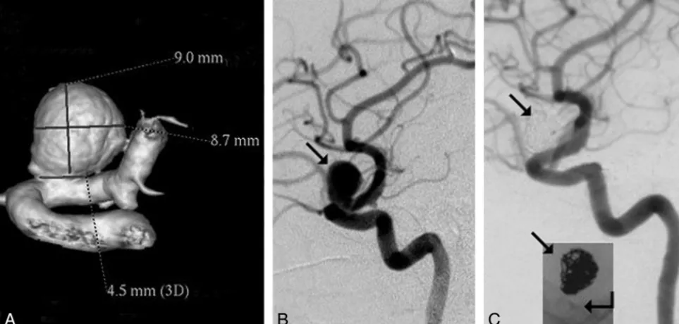 Fig 5. Results of aneurysm treatment with flow modification only.reconstruction of the parent artery (arrow A and B, Aneurysm with size and location similar to the one on Fig 4 (10-mm diameter paraophthalmic ICA aneurysm;, B) treated with flow modification
