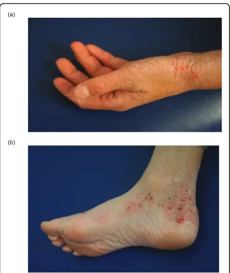 Figure 1 Atopic dermatitis (AD) of the flexural surfaces of theextremities.