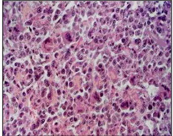 Figure 3. Giant cell tumor consists of uniformly distributed giant cells surrounded by round to oval mononuclear cells that rapidly proliferated