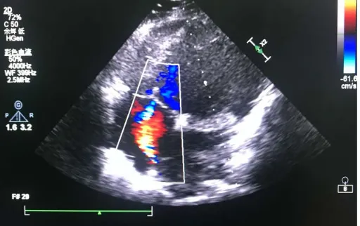 Figure 3. Demonstrates the color-Doppler left-to-right shunt across a created restrictive atrial septum defect (rASD); here during the ventricular systole an additional discrete tricuspid valve regurgitation is shown