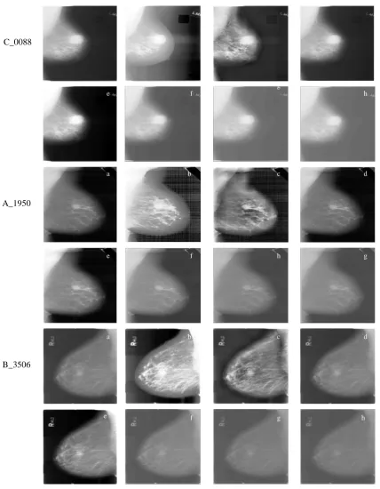 Fig. 2. Enhancement results for sample images from DDSM dataset (a) original image, (b) HE, (c) CLAHE, (d) unsharp masking, (e)-(h) proposed  fractional differential order technique with  α=0.2, α=0.3, α=0.4, and α=0.5