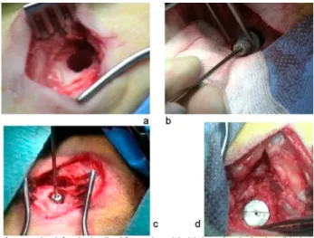 Figure 2: Study I, HA/Collagen substitute around the titanium implant by  adding BMA 
