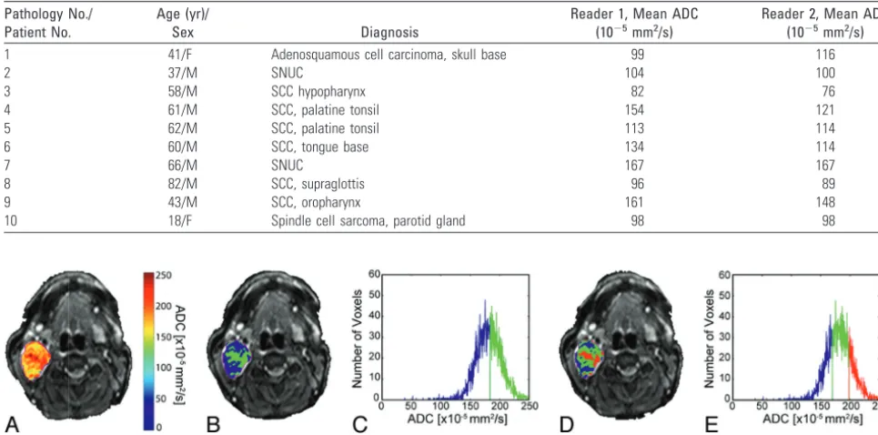 Table 2: ADC values obtained in 10 malignant neck pathologies by readers 1 and 2
