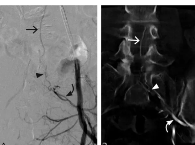 Fig 1. Case 1. A 56-year-old man with a left T7 SDAVF. A, Conventional DSA AP view. B, 3D C-arm conebeam axial MPR CT angiogram