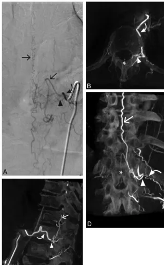 Fig 3. Case 3. A 76-year-old man with a left T12 SDAVF. A, Conventional DSA AP view. B, 3D C-arm conebeam axial MPR CT angiogram