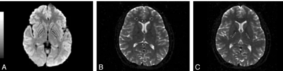 Fig 1. Depictions of regions of interest used in this study. A, T2-weighted trace image