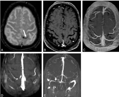 Fig 3. Seventy-six-year-old man with acute venous thrombosis involving left parietal cortical vein (thrombus age approximately 1 day)