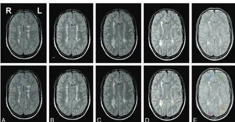 Fig 2. Early-echo (Pd) images from a T2-weighted 2D dual-echo fast spin-echo sequence used to identify and outline focal WM lesions, DAWM, and NAWM