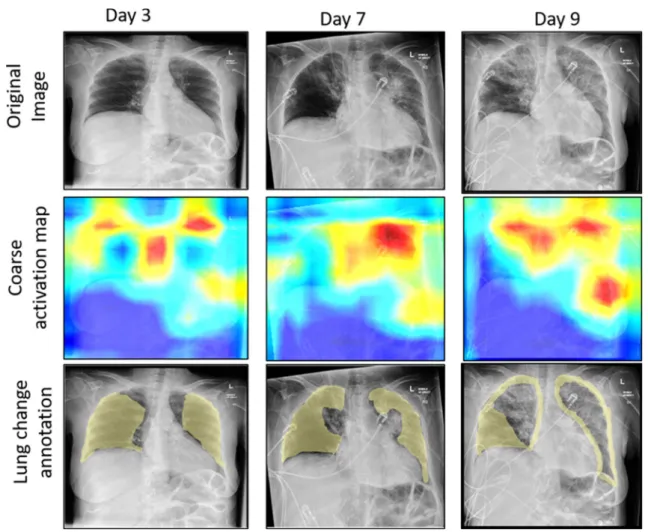 Fig. 8 Coarse activation map visualization for a patient’s X-ray in ICU-care at day 3, 7 and 9, visualising increased inflammation (e.g.