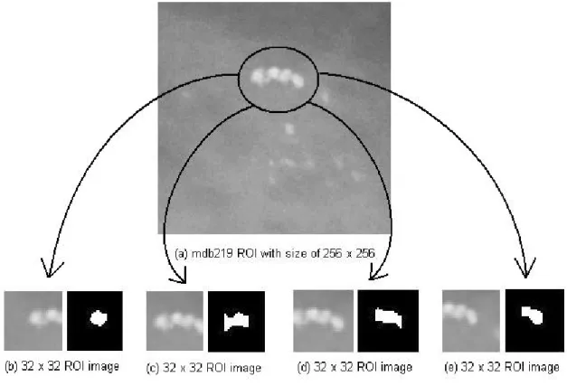 Figure 3.17 The original image of a cluster of microcalcifications from mammogram image mdb219  in (a)
