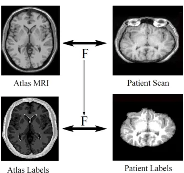 Figure 1.1: Block diagram illustrating the atlas-based segmentation procedure used for brain tissue segmentation