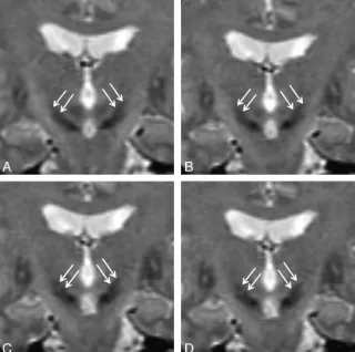 Fig 2. Coronal T2-weighted images showing the STN in afront of(This section is located 1 mm in front ofanterior limit of the red nuclei