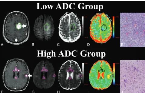 Fig 1. Comparison of diffusion-weighted imaging (DWI) and cellular density between high and low apparent diffusion coefficient (ADC) groups (image with regions of interest surrounding enhancing regions that were pathologically diagnosed as primary central 