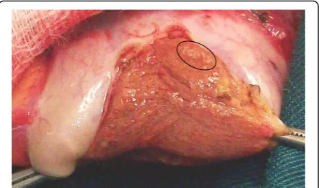 Fig. 7 Dilated tubules in the lateral aspect of a 5 ml testis with ahigh FSH range and predominant Sertoli Cell Only pattern