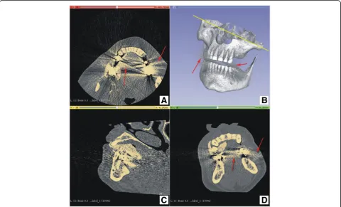 Fig. 1 CT scan errors: a) incomplete image; b) x-ray scatter artifacts from metal objects in the patient tissues and cavities
