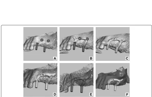 Fig. 6 modeling principle:fstructures and modelled (bulked) implant merged with original model;model onto which implant was modelled (orange); a) original model of the jaw; b) pre-made structures (loops and abutments) added on to virtual model; c) pre-made