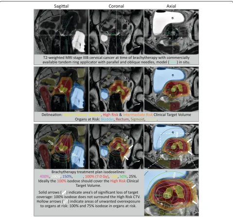 Fig. 1 Limitations of an advanced standard applicator with parallel and oblique interstitial needles is demonstrated in a patient with a tumourinvolving the lateral parametrium