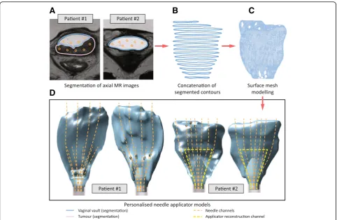 Fig. 2 Illustration of data processing steps, including a) segmentation of MR images, b) concatenation of segmented contours, c) surface meshmodelling, and d) applicator designs for two patients