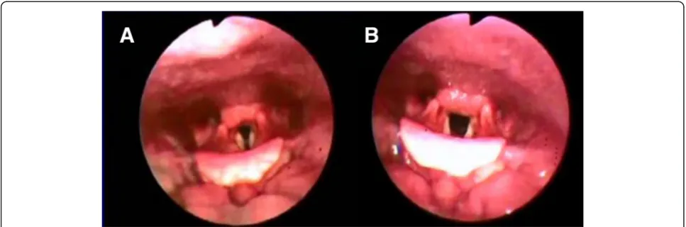Fig. 1 a Images taken during laryngoscopy showing paradoxical adduction detected during mid-inspiration in a patient with vocal cord dysfunctionb Appropriate movement of the vocal cords during mid-inspiration in the same patient following speech therapy