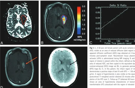 Fig 1. A(KPS) maps (region of interest is placed within the infarct, defined as the corearea of reduced ADC, and then copied to the equivalent dynamiccontrast-enhanced (DCE) image set (demonstrates a positive slope of best fit with KPSg/min