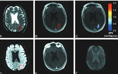 Fig 3. Ato generate KPS maps (is administered during MR imaging. A region of interest is placed within the infarct, defined as the core area of reduced ADC, and then is copied to the equivalent DCE image set (, An 81-year old male patient with AIS, visible