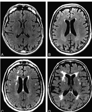 Fig 1. WMHs in prodromal regions. A�D, Examples ofWMHs in the bilateral periventricular frontal regions onFLAIR axial brain MR images that would be visually rated ata level of 0 (A), 1 (B), 2 (C), and 3 (D).