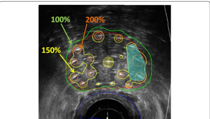 Fig. 6 Typical HDR prostate BT treatment plan showing axial midgland plane for a patient treated with 19 Gy