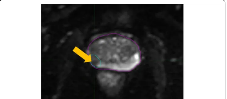 Fig. 1 Multiplanar T2-weighted fast-spin echo (T2W-FSE) images (axial, coronal, and sagittal midplanes) of a patient with localized prostate cancer treated with EBRT (45 Gy/25), followed by an HDR BT boost (15 Gy/1)