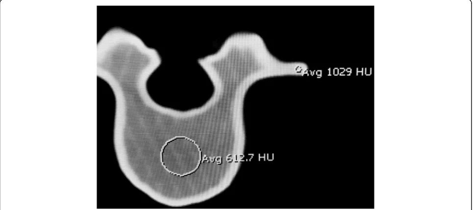 Fig. 4 Under CT, the lumbar spine model demonstrates Hounsfield Units that mimic cortical and medullary bone