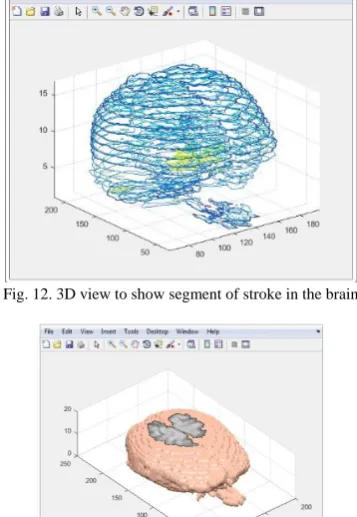 Fig. 12. 3D view to show segment of stroke in the brain   
