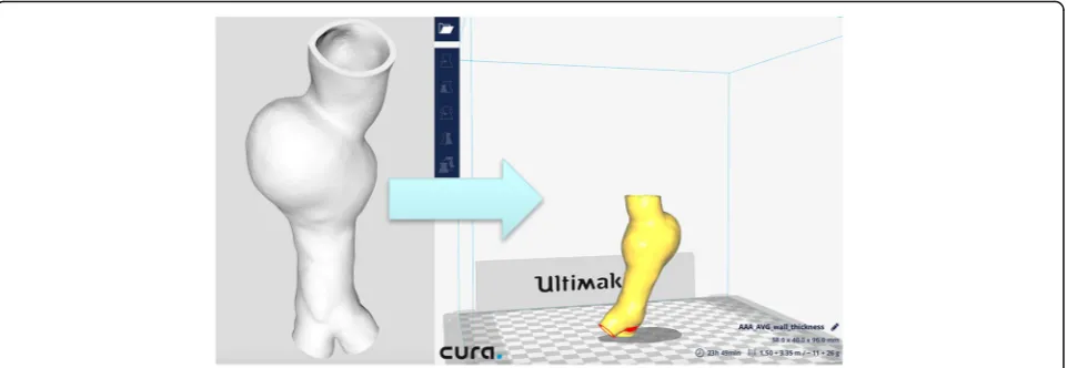 Fig. 1 Picture of the 3D reconstruction from the patient’s AAA geometry. The picture was obtained from CT scan data, which was transferred tothe software Cura (version 2.5, Ultimaker, Geldermalsen, Netherlands) for layer slicing and setting the 3D printing parameters
