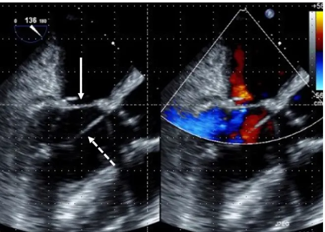 Figure 1. Preoperative transesophageal echocardiogram showing central mitral regurgi-tation (asterisk) with tethering of both leaflets; in particular, the anterior leaflet was te-thered due to secondary chordae and its mobility was severely restricted (arr