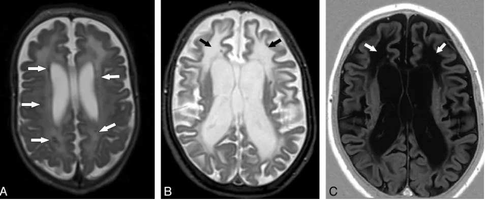 Fig 2. Cerebral calcifications.in patients with AGS. A, Axial nonenhanced CT image of case 1 shows numerous punctuate calcifications within the basal ganglia and the cerebral white matter, a pattern typical B, Contrast-enhanced CT scan (case 19) shows larg