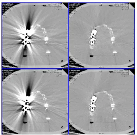 Fig. 2 Images of denture phantom scanned at 120 kV (artifact reduction algorithm extensively decreased the artifacts at both 120 kV (a) and 140 kV (c), showing no difference in metal artifact