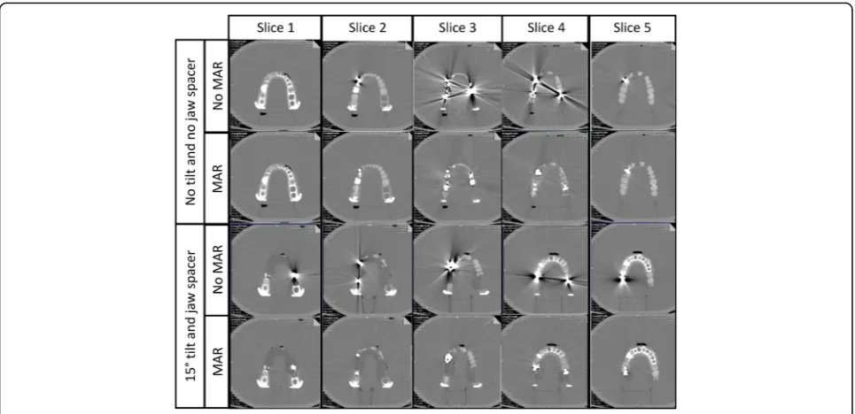 Fig. 6 Patient acquired without jaw spacer and no iterative metal artifact reduction algorithm (MAR) showing extensive metal artifact affectingmetal artifact by 90.8% (the display of the frontal upper teeth (a)