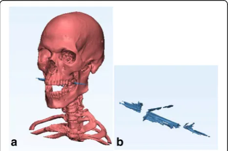 Table 2 Artifact Volume and segmentation time for 4 patientsreferred for head-and-neck acquisition and reconstructed withand without iterative metal artifact reconstruction
