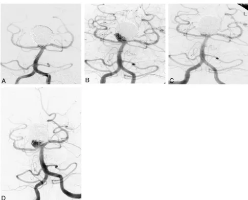 Fig 5. A, A 44-year-old man with a 20-mm basilar tip aneurysm embolized at an outside institution with rapid recanalization