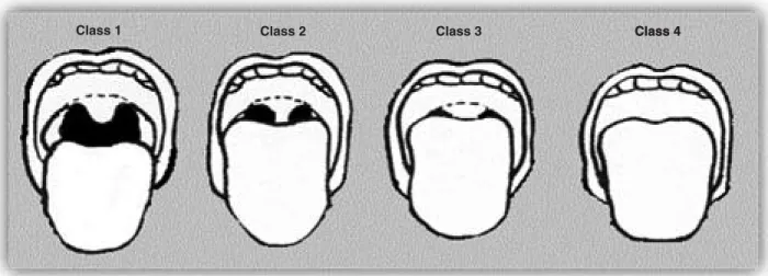 Figure 1.	Samsoon	and	Young’s	modification	of	the	Mallampati	classification	of	the	upper	airway	based	on	the	size	of	the	 tongue	and	pharyngeal	structures