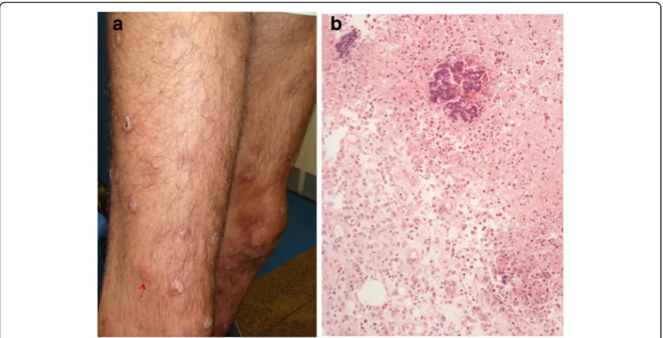 Fig. 9 Septic panniculitis in HIV positive male, caused by hematogenous dissemination.lower limbs