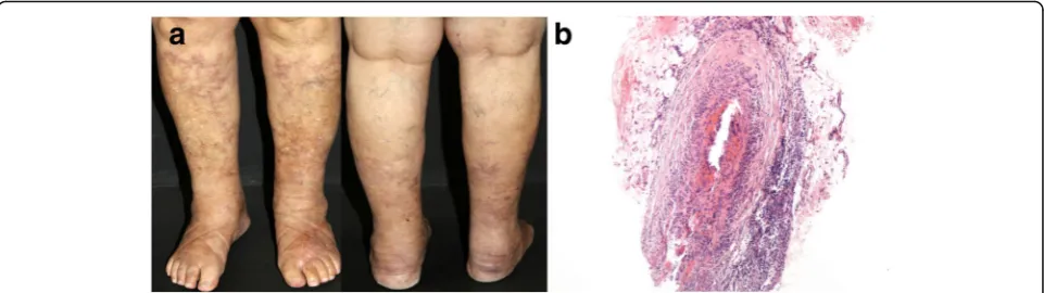 Fig. 5 Cutaneous polyarteritis nodosa. a Multiple infiltrated erythematous nodules mixed with livedo racemosa on the lower legs