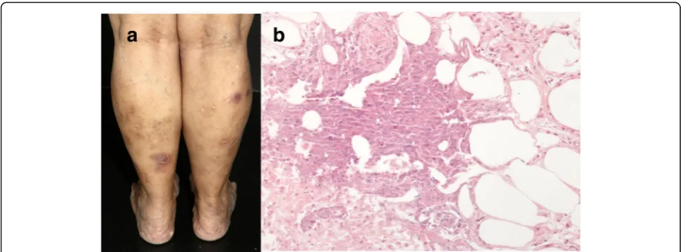 Fig. 8 Erythema induratum. a Erythematous nodules and atrophic scars in the legs. b Caseous necrosis in the lobules of the hypodermis.H&E, 400x