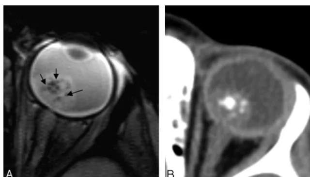 Fig 4. 3D gradient-echo T2-weighted image (A) shows focal signal-intensity loss, corresponding to a hyperattenuating area on the CT scan (B)