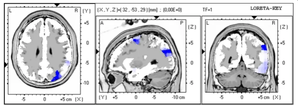 Fig. 5 LORETA non-parametric voxel-wise comparison map between F-MS and controls in the N1 time window