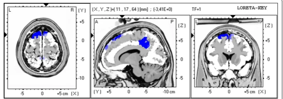Fig. 7 LORETA non-parametric voxel-wise comparison map between F-MS and NF-MS in the N2 time window