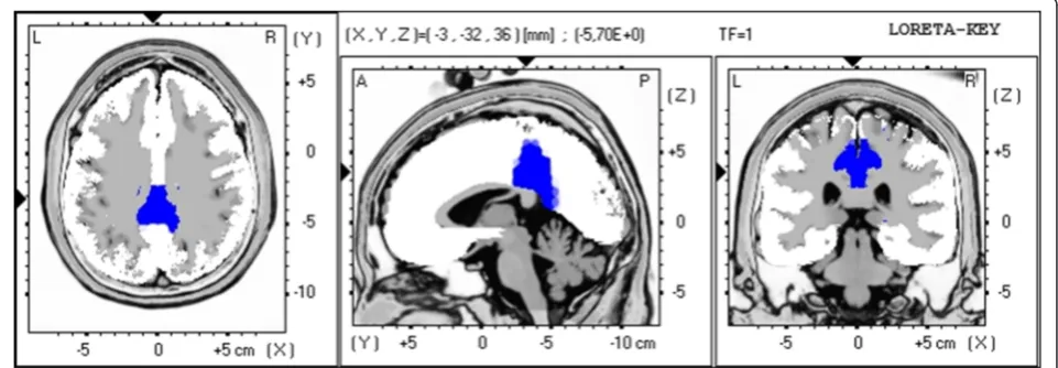 Fig. 9 Non-parametric voxel-wise comparison map between F-MS and NF-MS in the P3 time window