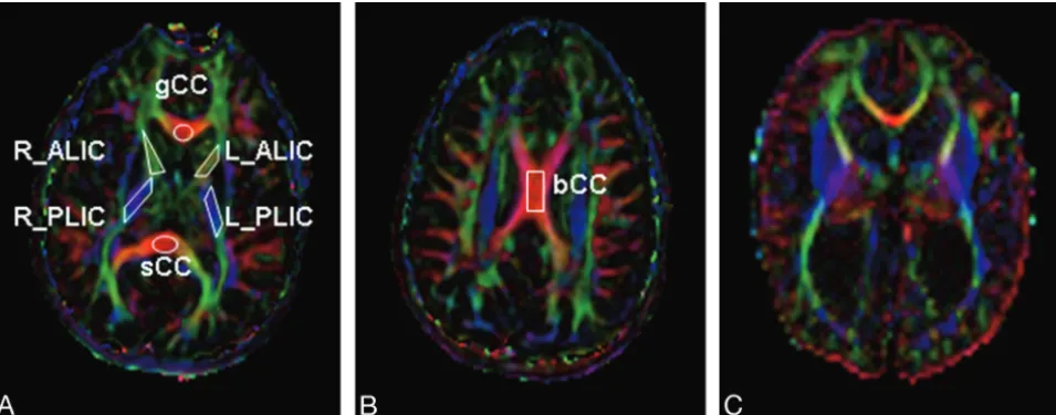 Fig 2. Color-coded FA maps for a child in the healthy control group (A and B) and a child with hydrocephalus in the preshunt group (C)