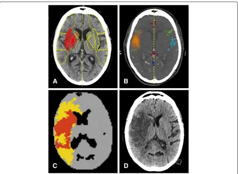 Fig. 3 Acute LVO with insufficient collateral flow and extended infarction despite successful recanalization: An 84-year-old woman suffered fromshows near complete infarction of the MCA territory