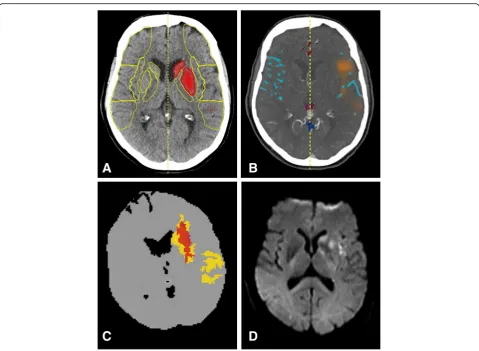 Fig. 4 Acute LVO with sufficient collateral flow, successful recanalization and good outcome: A 77-year-old woman suffered from an acutenucleus being affected, but e-CTA collateral score was 2 (54%,hemiparesis and aphasia (NIHSS 17) due to an left-sided M1