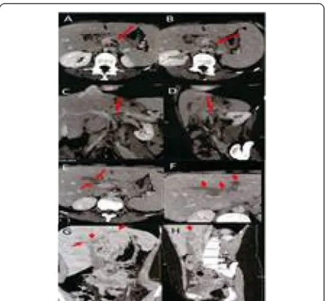 Fig. 1 (abstract P195). Computed tomography images of totalabdomen with contrast application showing thrombi in the splenic vein(A and B - axial sections, C - coronal section and D - sagittal section) andin the intrahepatic portion of the portal vein (E and F – axi)