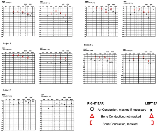 Figure 2: Pure‐tone audiograms from the five PCD subjects  